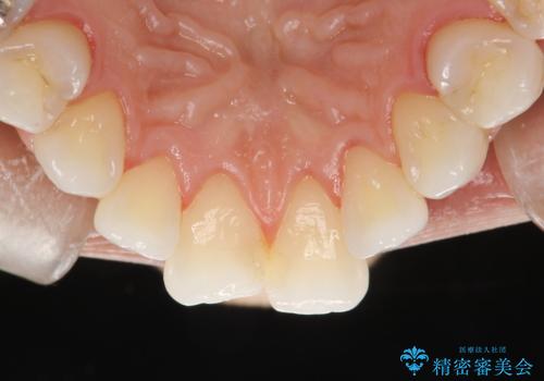 PMTCで歯石やステインの除去の治療後