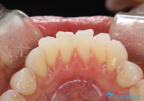 PMTCで歯石やステインの除去の治療後