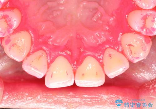 部分矯正中のクリーニングの治療中