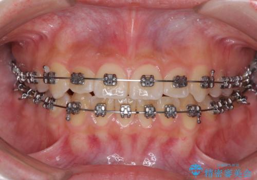 前歯のクロスバイト　メタル装置での矯正治療の治療中