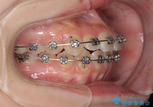 前歯のクロスバイト　メタル装置での矯正治療の治療中