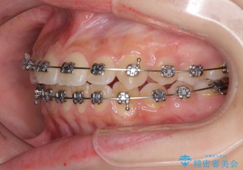 前歯のクロスバイト メタル装置での矯正治療の治療中
