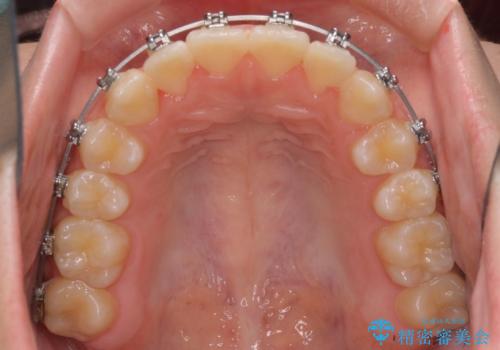 前歯のクロスバイト メタル装置での矯正治療の治療中