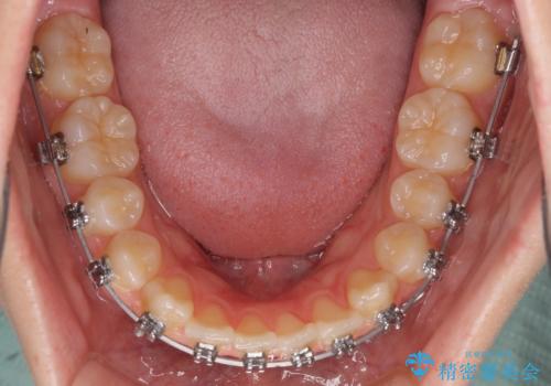 前歯のクロスバイト メタル装置での矯正治療の治療中
