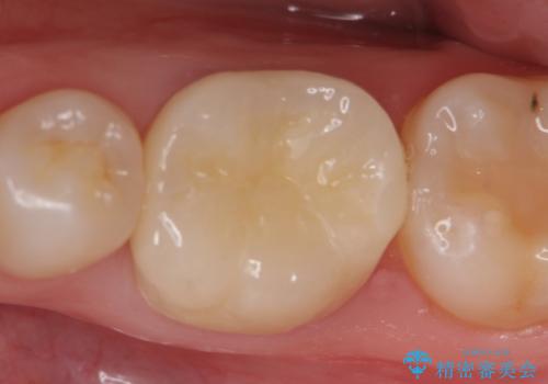 オールセラミッククラウン　他院にて抜歯を提案された歯の治療の症例 治療後