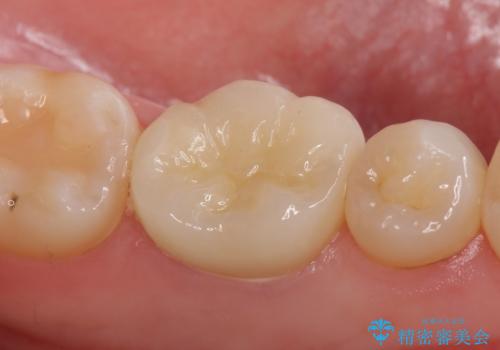 オールセラミッククラウン 他院にて抜歯を提案された歯の治療の治療後