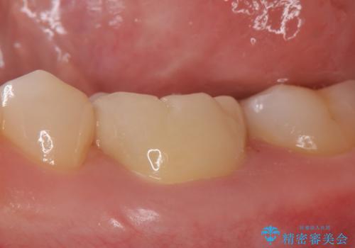 オールセラミッククラウン 他院にて抜歯を提案された歯の治療の治療後