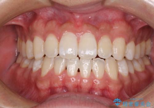 下顎前歯と上顎の部分矯正の症例 治療後