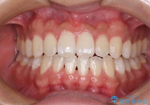 下顎前歯と上顎の部分矯正