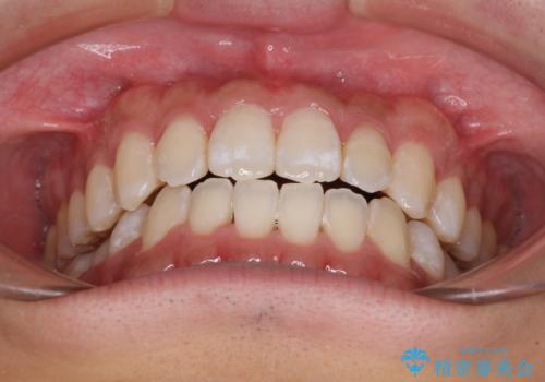 下顎前歯と上顎の部分矯正の治療後