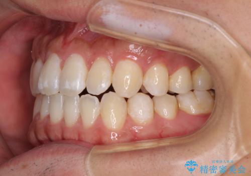 下顎前歯と上顎の部分矯正の治療後
