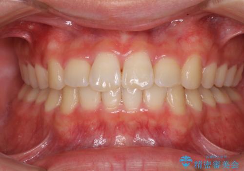 深い咬み合わせとデコボコ ワイヤー矯正で短期治療の症例 治療後