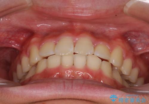 深い咬み合わせとデコボコ ワイヤー矯正で短期治療の治療後