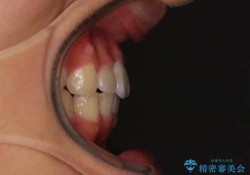 深い咬み合わせとデコボコ ワイヤー矯正で短期治療の治療後