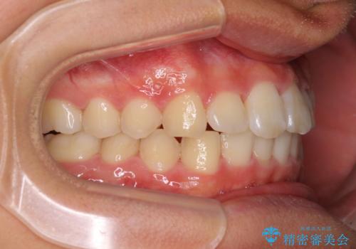 深い咬み合わせとデコボコ ワイヤー矯正で短期治療の治療後