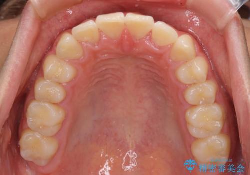 深い咬み合わせとデコボコ ワイヤー矯正で短期治療の治療後