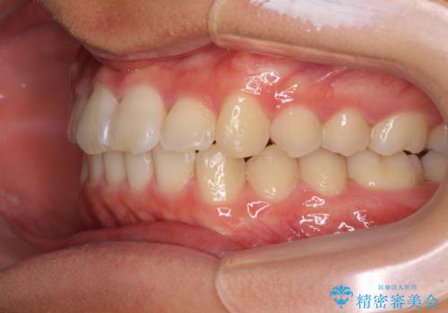 深い咬み合わせとデコボコ ワイヤー矯正で短期治療の治療後