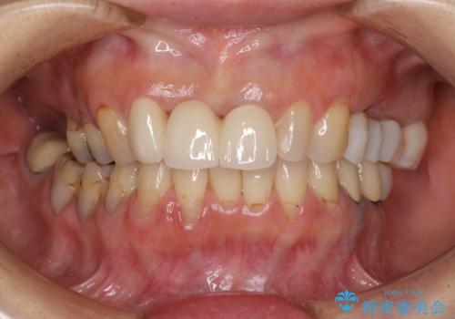 折れてしまった前歯 オールセラミックブリッジで自然な口元にの治療後