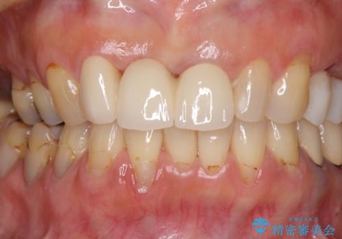 折れてしまった前歯 オールセラミックブリッジで自然な口元にの治療後