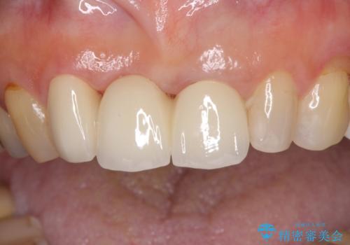 折れてしまった前歯 オールセラミックブリッジで自然な口元にの治療後