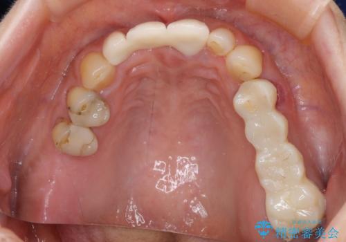 折れてしまった前歯 オールセラミックブリッジで自然な口元にの治療後