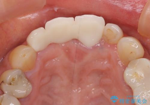 折れてしまった前歯 オールセラミックブリッジで自然な口元にの治療後
