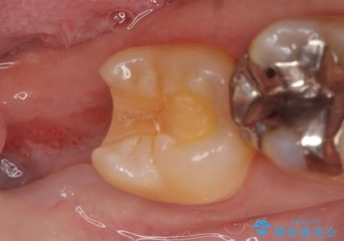 PGA(ゴールド)インレー　深い虫歯の治療の治療中