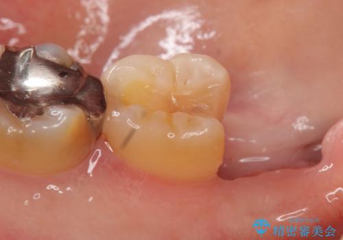 PGA(ゴールド)インレー 深い虫歯の治療の治療中