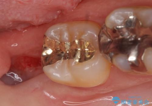 PGA(ゴールド)インレー　深い虫歯の治療の治療後
