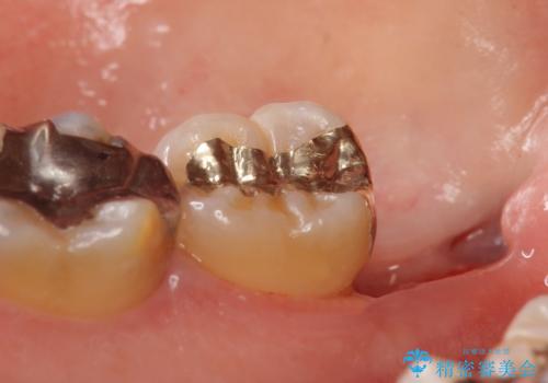 PGA(ゴールド)インレー 深い虫歯の治療の治療後