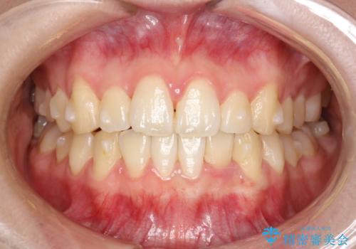 インビザライン矯正治療が終わり、アタッチメント除去と合わせて歯のクリーニングの治療前