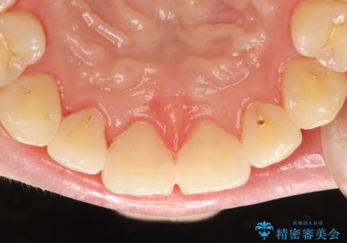 インビザライン矯正治療が終わり、アタッチメント除去と合わせて歯のクリーニングの治療後