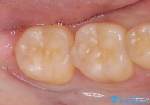 セラミックインレー 冷たいものがしみる奥歯の治療の症例 治療後