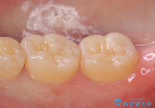 セラミックインレー 冷たいものがしみる奥歯の治療の治療後