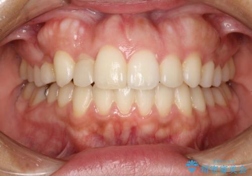 矯正治療が終わった後にクリーニング PMTC