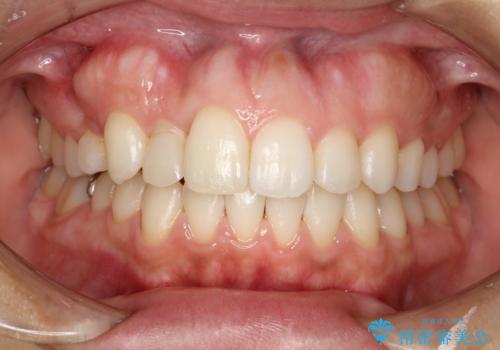 矯正治療が終わった後にクリーニング PMTCの治療後