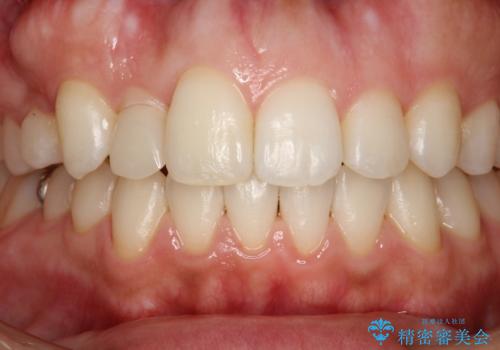 矯正治療が終わった後にクリーニング PMTCの治療後