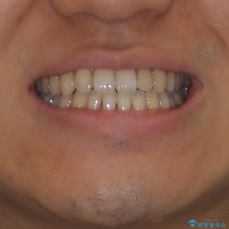 下顎前歯と上顎の部分矯正の治療後（顔貌）