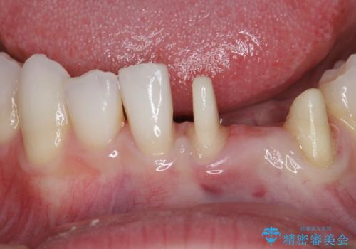 オールセラミッククラウン 矯正で綺麗に並ばなかった前歯の補綴の治療中