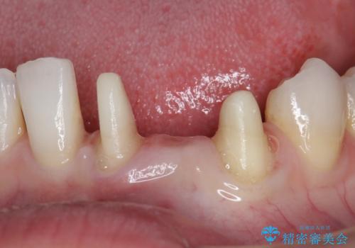オールセラミッククラウン 矯正で綺麗に並ばなかった前歯の補綴の治療中