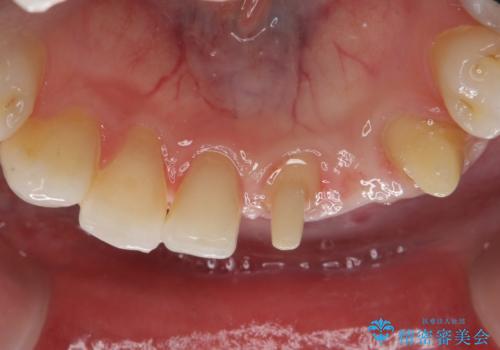 オールセラミッククラウン 矯正で綺麗に並ばなかった前歯の補綴の治療中