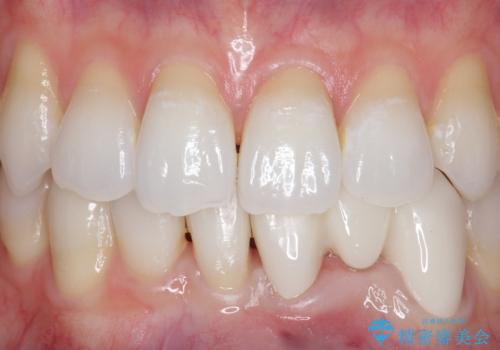 オールセラミッククラウン 矯正で綺麗に並ばなかった前歯の補綴の治療後