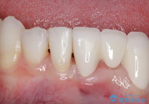 オールセラミッククラウン 矯正で綺麗に並ばなかった前歯の補綴の症例 治療後