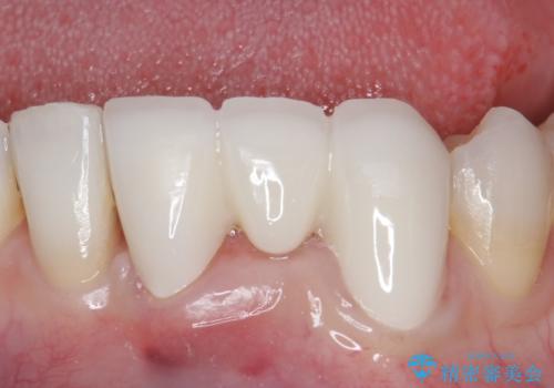 オールセラミッククラウン 矯正で綺麗に並ばなかった前歯の補綴の治療後