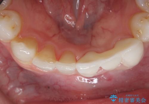 オールセラミッククラウン 矯正で綺麗に並ばなかった前歯の補綴の治療後