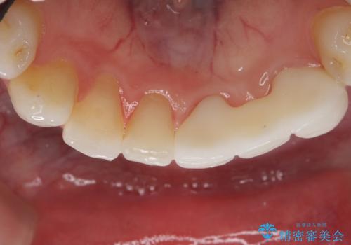 オールセラミッククラウン 矯正で綺麗に並ばなかった前歯の補綴の治療後