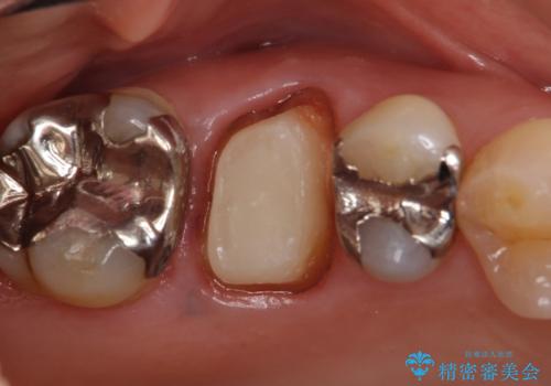 オールセラミッククラウン 銀歯と歯茎の隙間が気になるの治療中