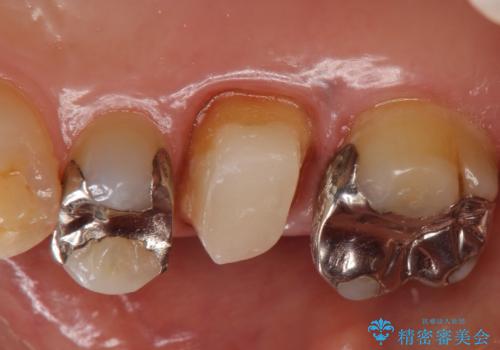 オールセラミッククラウン　銀歯と歯茎の隙間が気になるの治療中