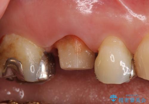 オールセラミッククラウン 銀歯と歯茎の隙間が気になるの治療中