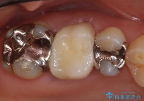 オールセラミッククラウン 銀歯と歯茎の隙間が気になるの治療後